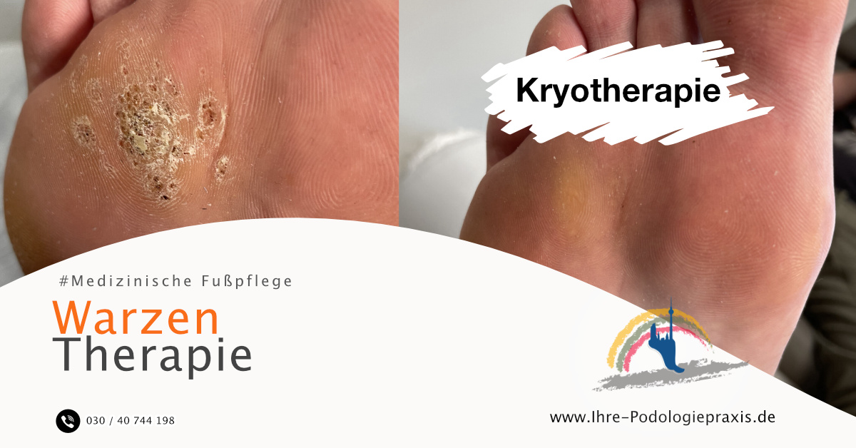 Gesunde Fußsohle nach Warzenbehandlung mit Kryotherapie
